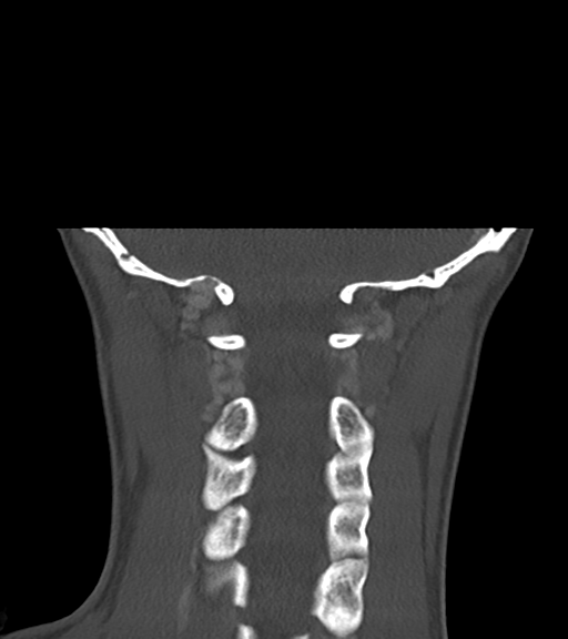 File:Cemento-ossifying fibroma (Radiopaedia 46243-50643 Coronal bone window 49).png