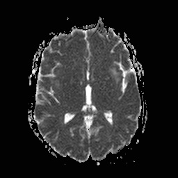 File:Central-variant posterior reversible encephalopathy syndrome (PRES) (Radiopaedia 43880-47358 Axial ADC 11).jpg