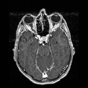 Central-variant posterior reversible encephalopathy syndrome (PRES) (Radiopaedia 43880-47358 Axial T1 C+ 52).jpg