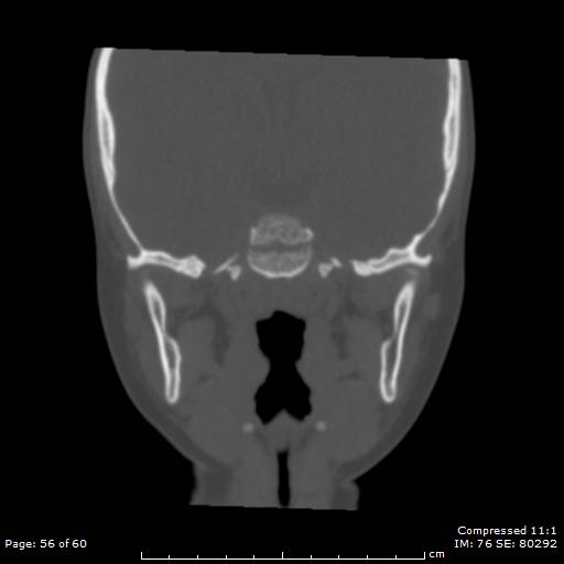 Central giant cell granuloma (Radiopaedia 45612-49754 Coronal bone window 56).jpg