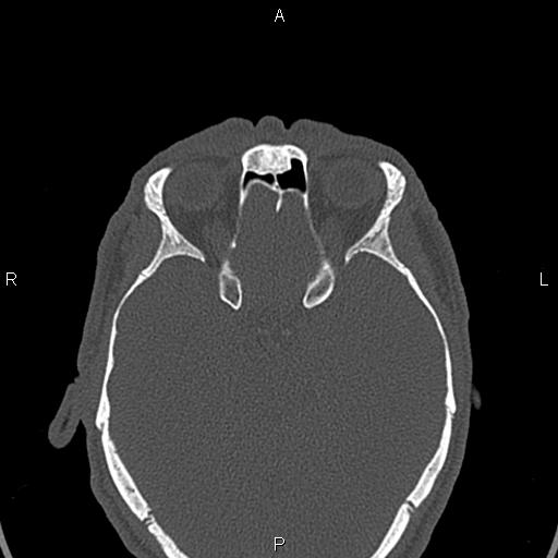 File:Central giant cell granuloma (Radiopaedia 83346-97761 Axial bone window 65).jpg