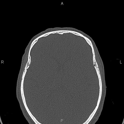File:Central giant cell granuloma (Radiopaedia 83346-97761 Axial bone window 84).jpg
