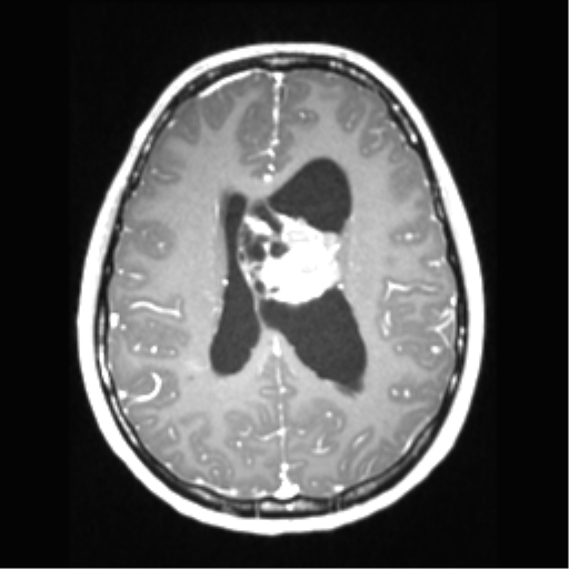 Central neurocytoma (Radiopaedia 37664-39557 Axial T1 C+ 50).png