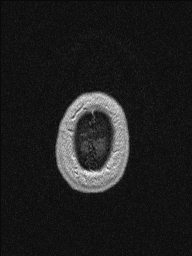 Central neurocytoma (Radiopaedia 56690-63469 Axial T1 C+ 158).jpg