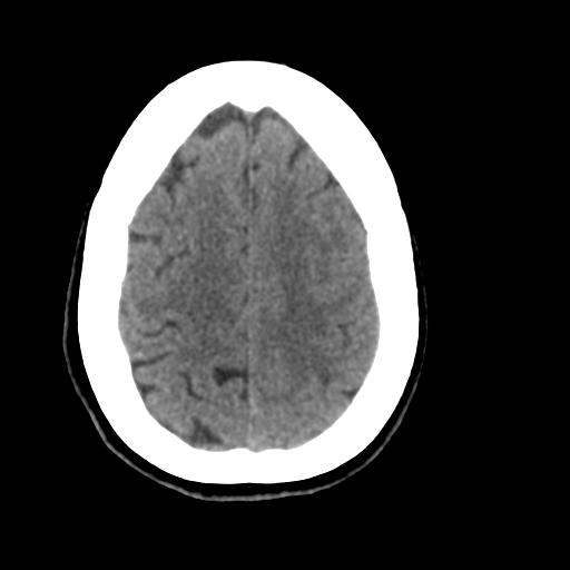 Central neurocytoma (Radiopaedia 65317-74346 Axial non-contrast 40).png