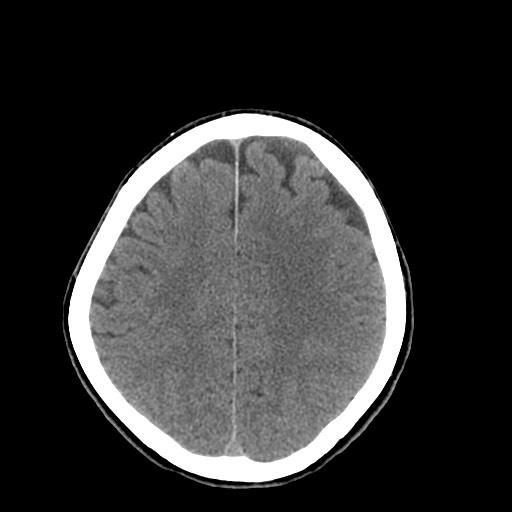 Central neurocytoma (Radiopaedia 68725-78432 Axial non-contrast 39).jpg