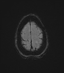 Central neurocytoma (Radiopaedia 84497-99872 Axial SWI 64).jpg