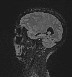 Central neurocytoma (Radiopaedia 84497-99872 Sagittal Flair + Gd 48).jpg