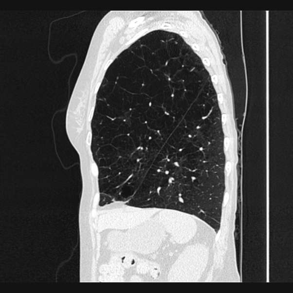 Centrilobular pulmonary emphysema (Radiopaedia 24495-24789 Sagittal lung window 65).jpg
