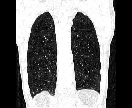 Centrilobular pulmonary emphysema (Radiopaedia 62468-70718 Coronal lung window 60).jpg
