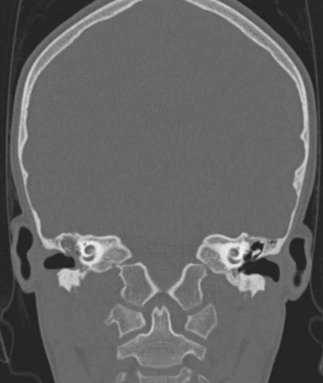 Cerebellar abscess (Radiopaedia 73727-84527 Coronal bone window 63).jpg