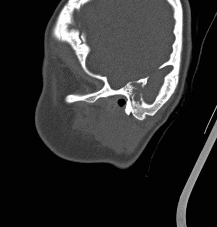 Cerebellar abscess (Radiopaedia 73727-84527 Sagittal bone window 36).jpg