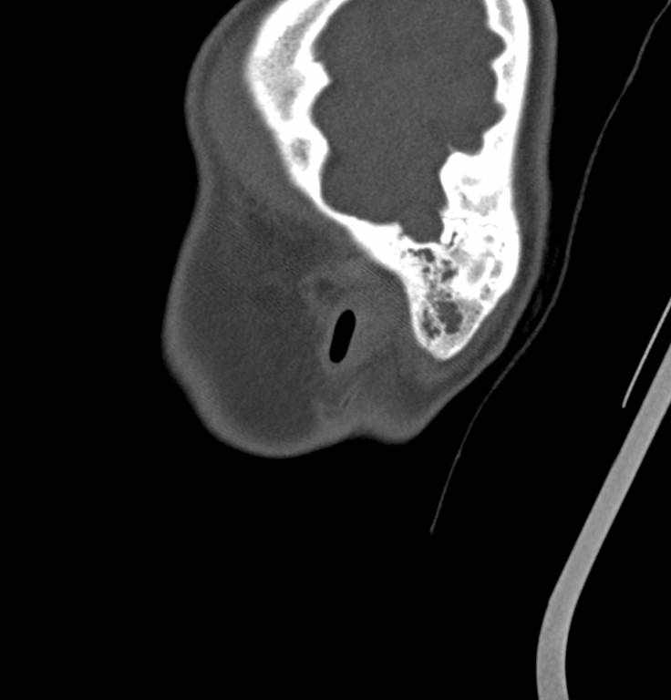 Cerebellar abscess (Radiopaedia 73727-84527 Sagittal bone window 43).jpg