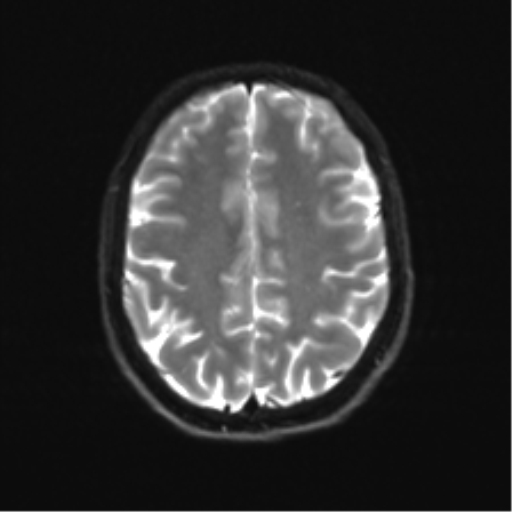 Cerebellar agenesis with hypoplastic pons (pontocerebellar hypoplasia) (Radiopaedia 57224-64138 Axial DWI 28).png