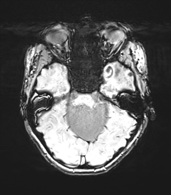 Cerebellar agenesis with hypoplastic pons (pontocerebellar hypoplasia) (Radiopaedia 57224-64138 Axial SWI 30).png