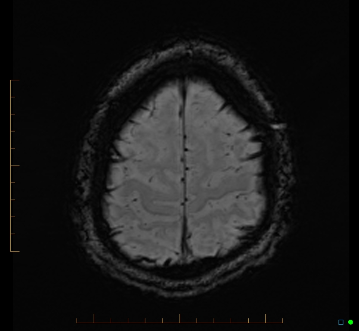 Cerebellar gangliocytoma (Radiopaedia 65377-74422 Axial SWI 53).jpg