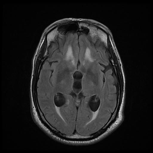 File:Cerebellar hemangioblastoma (Radiopaedia 88055-104622 Axial FLAIR 14).jpg