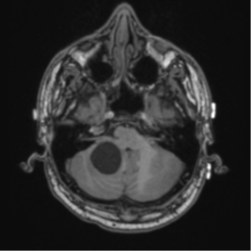 Cerebellar hemangioblastomas and pituitary adenoma (Radiopaedia 85490-101176 Axial T1 17).png