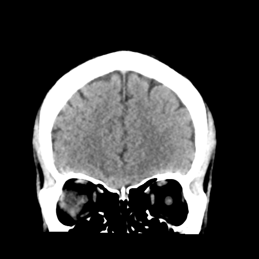 File:Cerebellar hemorrhage (Radiopaedia 37000-38669 Coronal non-contrast 11).png