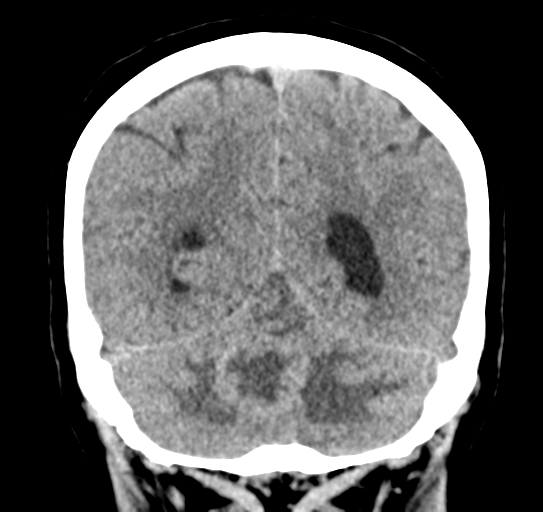 File:Cerebellar metastasis (Radiopaedia 54578-60812 Coronal non-contrast 44).png