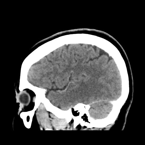 Cerebellar metastasis (cystic appearance) (Radiopaedia 41395-44258 F 40).png