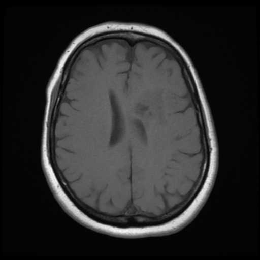 File:Cerebellar metastasis (cystic appearance) (Radiopaedia 41395-44268 Axial T1 16).png