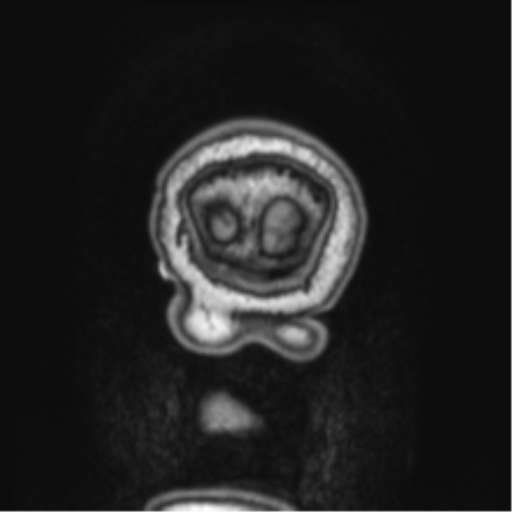 Cerebellar metastasis from lung adenocarcinoma (Radiopaedia 86690-102829 Coronal T1 3).png