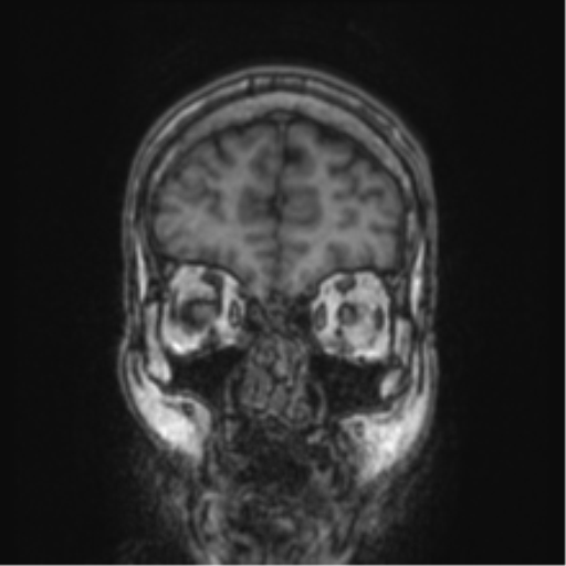 File:Cerebellar metastasis from lung adenocarcinoma (Radiopaedia 86690-102829 Coronal T1 84).png
