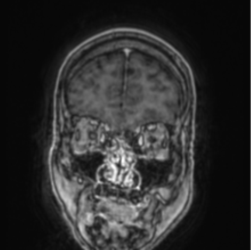 Cerebellar metastasis from lung adenocarcinoma (Radiopaedia 86690-102829 Coronal T1 C+ 82).png