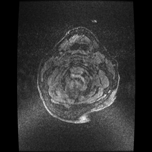 Cerebellar metastasis of pulmonary adenocarcinoma, cavernous venous malformation, and developmental venous anomaly (Radiopaedia 85827-101661 Axial T1 C+ 94).jpg