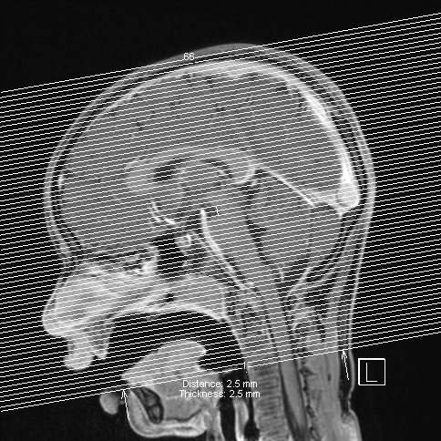 Cerebellar stroke (Radiopaedia 32202-33150 Axial T1 C+ 67).png