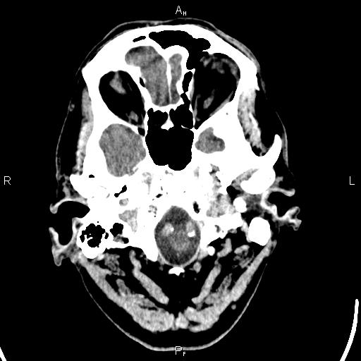 Cerebellopontine angle arachnoid cyst (Radiopaedia 85149-100704 Axial With contrast 3).jpg