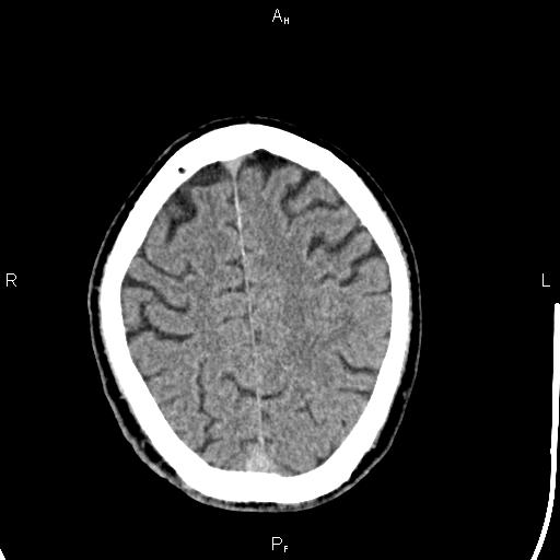 Cerebellopontine angle arachnoid cyst (Radiopaedia 85149-100704 Axial With contrast 40).jpg
