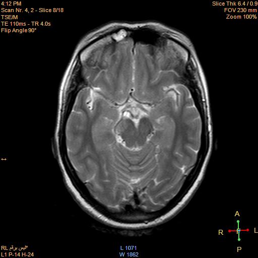 File:Cerebellopontine angle meningioma (Radiopaedia 22488-22525 Axial T2 6).jpg