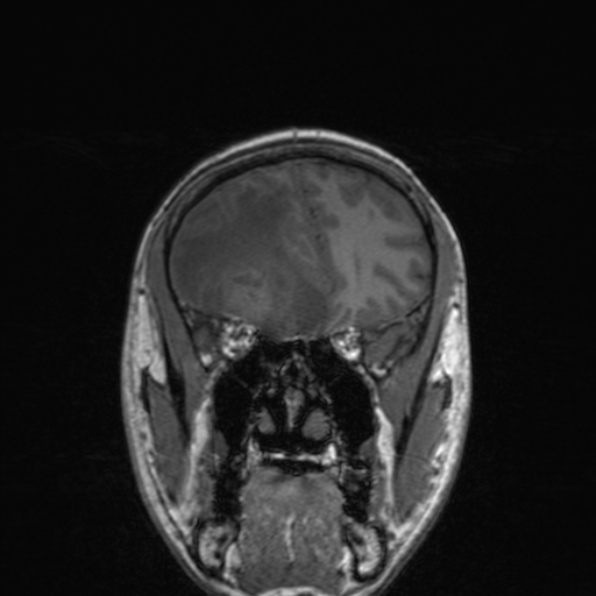 File:Cerebral abscess (Radiopaedia 24212-24478 Coronal T1 68).jpg