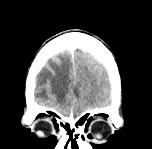 Cerebral abscess (Radiopaedia 60342-68008 Coronal C+ delayed 11).png