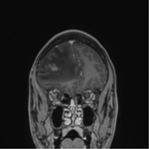 File:Cerebral abscess (Radiopaedia 60342-68009 H 42).png