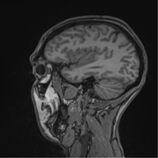 Cerebral abscess (Radiopaedia 60342-68009 Sagittal T1 17).png