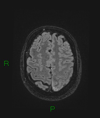Cerebral abscess and subdural empyema (Radiopaedia 84436-99779 Axial FLAIR 22).jpg