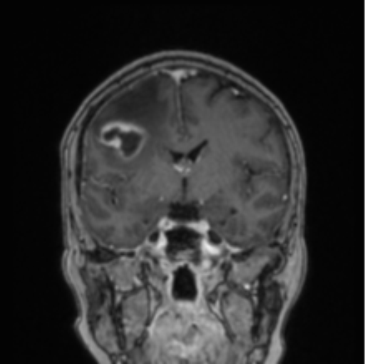 Cerebral abscess from pulmonary arteriovenous malformation (Radiopaedia 86275-102291 L 51).png