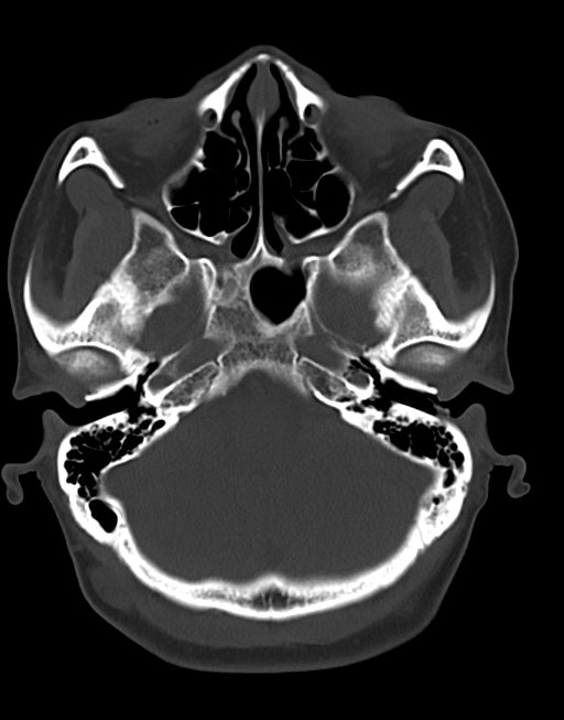 Cerebral abscesses (Radiopaedia 70458-80568 Axial bone window 16).jpg