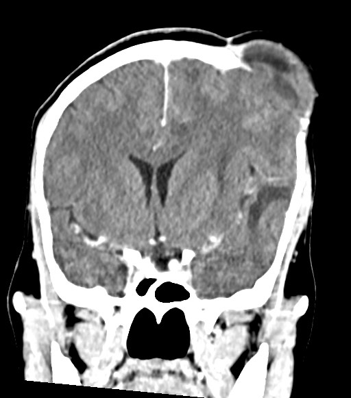 Cerebral abscesses (Radiopaedia 70458-80568 Coronal Contrast 28).jpg