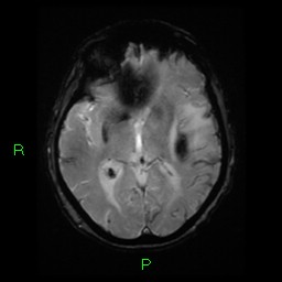 File:Cerebral amyloid angiopathy-associated lobar intracerebral hemorrhage (Radiopaedia 58376-65512 Axial Gradient Echo 14).jpg