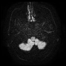 Cerebral amyloid angiopathy (Radiopaedia 28698-28978 Axial DWI 3).jpg