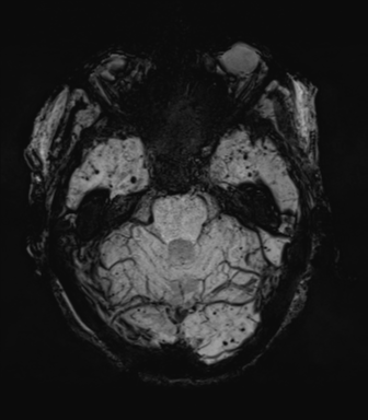 Cerebral amyloid angiopathy (Radiopaedia 46082-50433 Axial SWI MIP 21).png