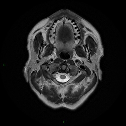 File:Cerebral amyloid angiopathy (Radiopaedia 77506-89664 Axial T2 1).jpg