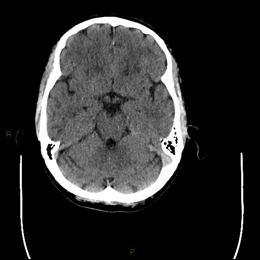 Cerebral amyloid angiopathy (Radiopaedia 77506-89665 Axial non-contrast 37).jpg