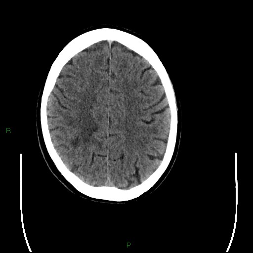 Cerebral amyloid angiopathy (Radiopaedia 77506-89665 Axial non-contrast 78).jpg