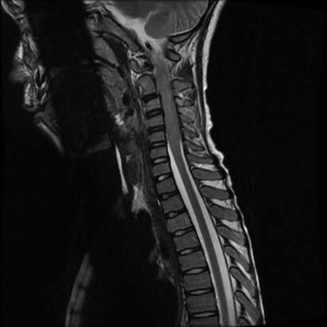 File:Cerebral and spinal tuberculosis (Radiopaedia 90489-107838 Sagittal 5).jpg