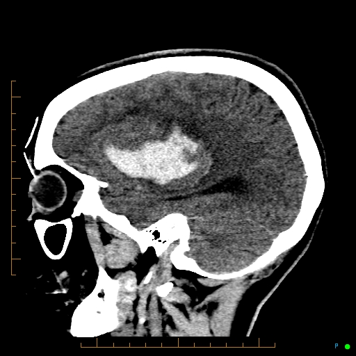 Cerebral arteriovenous malformation (AVM) (Radiopaedia 78162-90706 A 23).jpg
